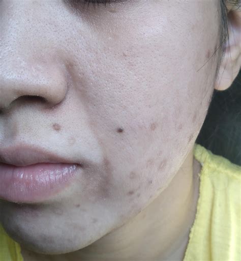 [Skin Concerns][Acne] : r/SkincareAddiction