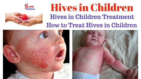 Hives On Face Treatment - Doctor Heck