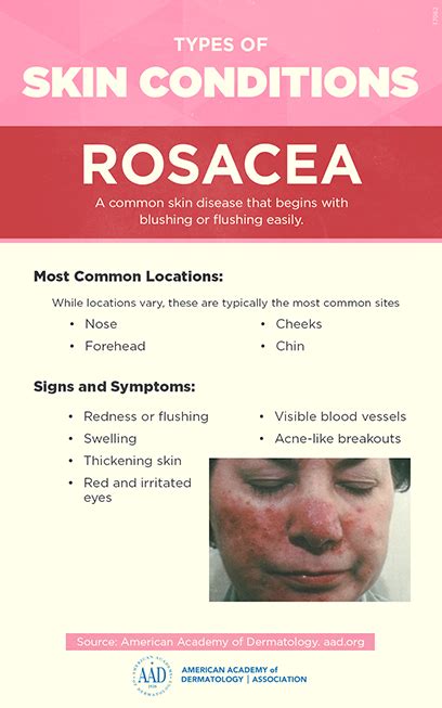 Rosacea: Who gets and causes