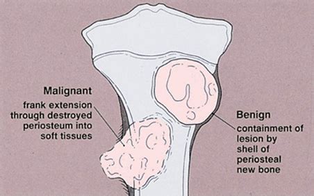 10 Best Clinics for Benign Bone Tumor Removal in Taiwan [2023 Prices]