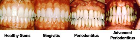 Gum Disease - Thomas J Munger, III DDS