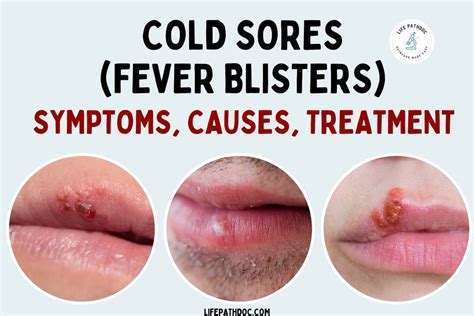 Cold Sores: Causes, Treatment Fever Blisters Vs Cold Sores, 40% OFF