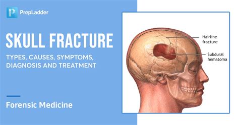 Skull Fracture: Types, Causes, Symptoms, Diagnosis And Treatment