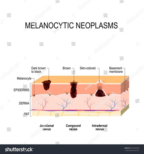 Melanocytic nevus. junctional, compound and - Royalty Free Stock Vector 765445528 - Avopix.com