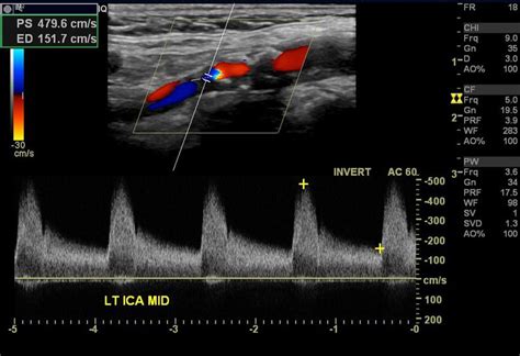 Ultrasound Of Carotid Artery