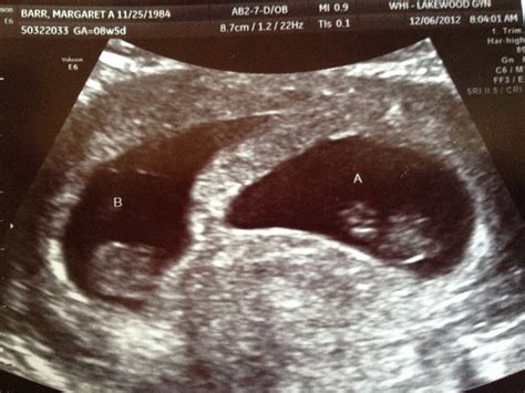 Twin Parenting: Twin ultrasound 8 weeks