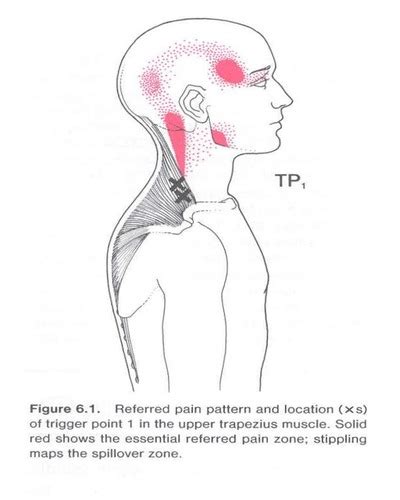 Levator Scapulae Trigger Points