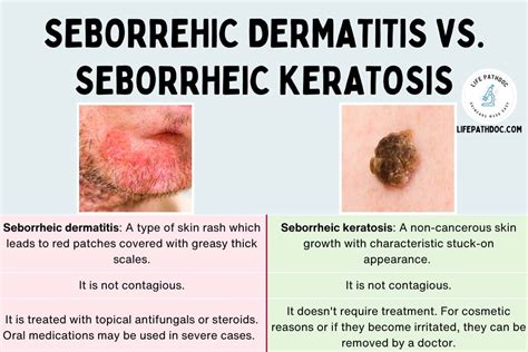 Seborrheic Dermatitis vs. Seborrheic Keratosis (with Pictures)