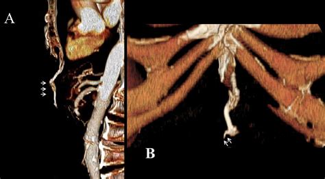 Figure 1 from Xiphodynia Mimicking Acute Coronary Syndrome. | Semantic Scholar