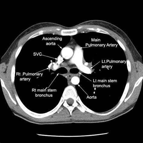 CT Scan Tips & Protocols: HEMATURIA CT PROTOCOL / CT UROGRAM Protocol