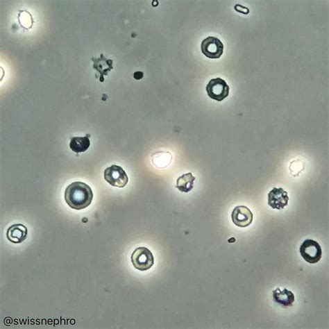 Dysmorphic RBCs in a patient with IgA nephropathy. (Phase contrast x400) #urinarysediment #urine ...