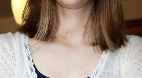 What is a Hickey and How to Give Yourself One