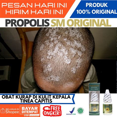 Jual Obat Penghilang Kurap Parah di Kulit Kepala, Obat Kurap di Kepala Anak, Kepala Korengan ...