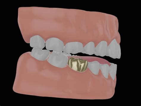 How Long Do Crowns Last? Comparing Tooth Crown Longevity