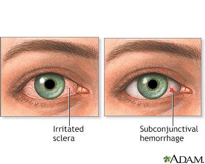 HIE Multimedia - Eye redness