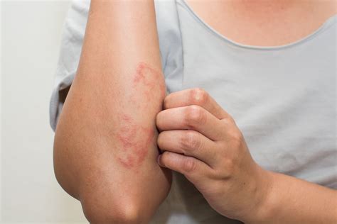 What Does Eczema Look Like? 5 Signs to Never Ignore | The Healthy