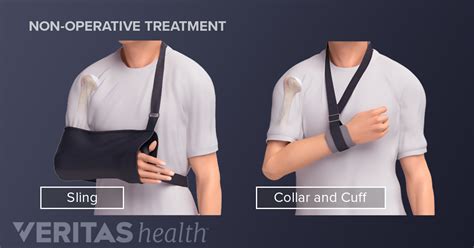 Treating a Clavicle Fracture