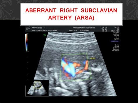 Screening for fetal aneuploidy