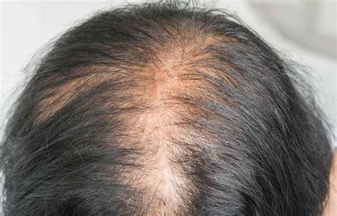 Androgenic Alopecia – Causes, Treatment, And More