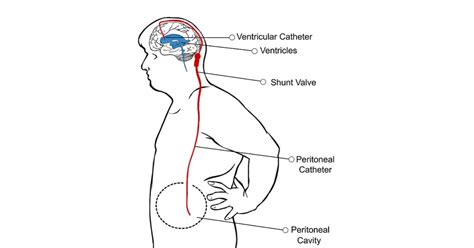 What Is A Ventriculoperitoneal Shunt