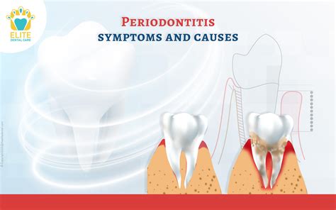 Periodontitis and its Symptoms | Elite Dental Care