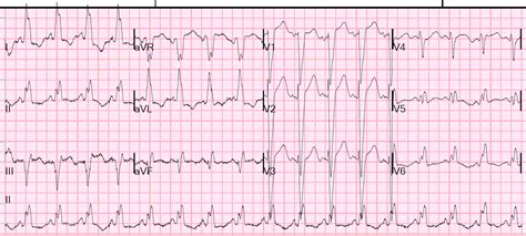 Dr. Smith's ECG Blog: Wide Complex Tachycardia with Fusion and Capture ...