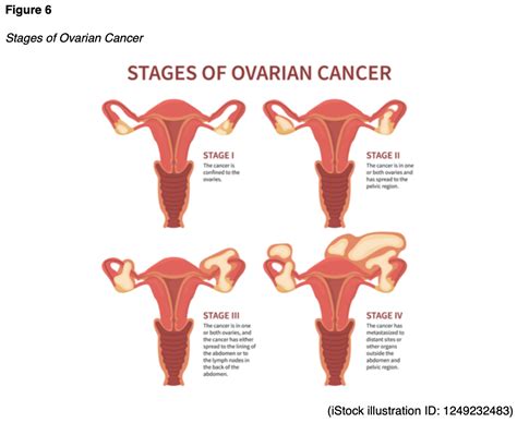 Ovarian Cancer for RNs and LPNs Nursing CE Course | NursingCE