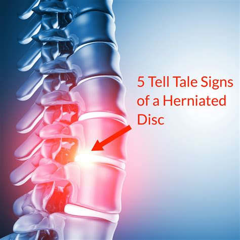 5 Tell Tale Signs of a Herniated Disc (Slipped Disc) - Fornham Chiropractic Clinic