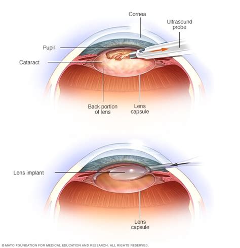 Cataract surgery - Mayo Clinic