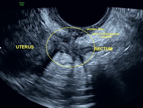 Can you be diagnosed with endometriosis from an ultrasound ...