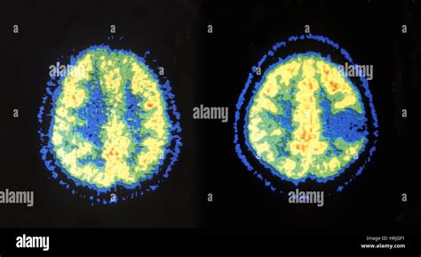 Abnormal Brain CT Scan