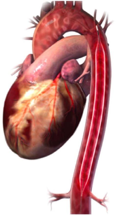 Reporting Intra-Aortic Balloon Pump (IABP) In ICD-10-PCS, 59% OFF