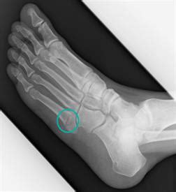 5th Metatarsal Fracture Surgery Procedure & Recovery