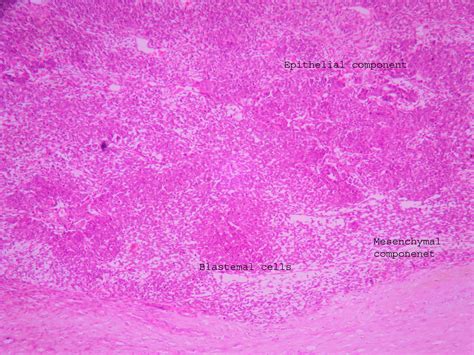 Wilm’s tumor – UG slide – Histopathology.guru