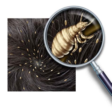 Types Of Lice And Common Head Lice Symptoms - Lice Clinics USA