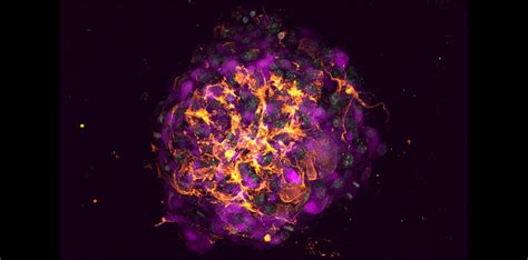 Image of the Month: Breast cancer organoid