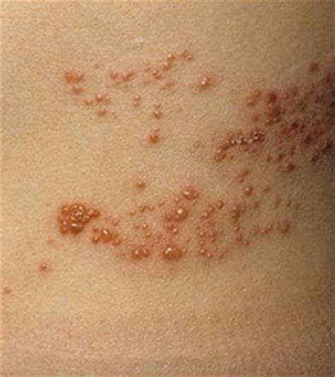 Sun Poisoning - Pictures, Rash Causes, Treatment | Health Momma