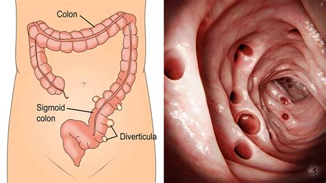 7 Symptoms of Diverticulitis (And Natural Remedies To Help Fix It ...