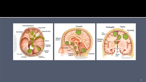 Petroclival Meningioma