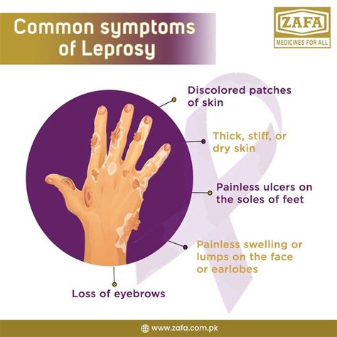 Symptoms Of Leprosy in 2023 | Ulcers, Symptoms, Drawing sheet