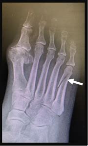 5th Metatarsal Shaft "Dancer's" Fracture - FootEducation