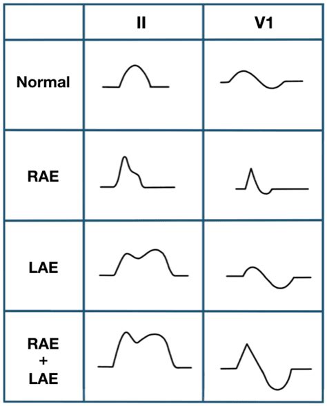 P wave • LITFL • ECG Library Basics