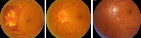 What is NAION and Is Eyesight Loss Irreversible? Research and Practice