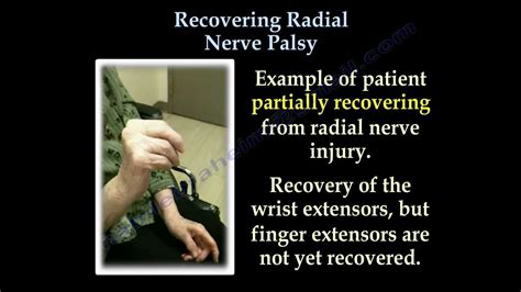 radial nerve palsy exercise - Captions Prince