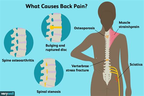 Back Pain: Causes, Treatment, and When to See a Healthcare Provider