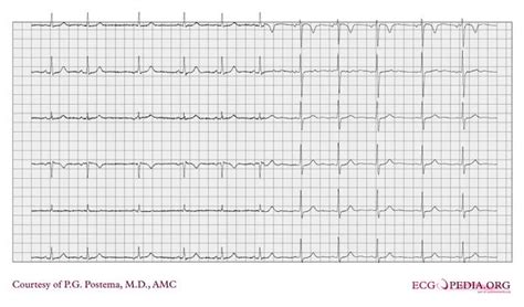 Sino-atrial exit block - ECGpedia