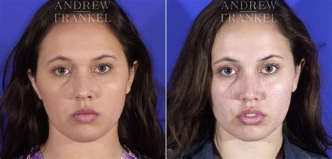 Buccal Fat Removal photos | Beverly Hills, CA. | Patient 11514