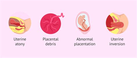 Causes of post-partum haemorrhage