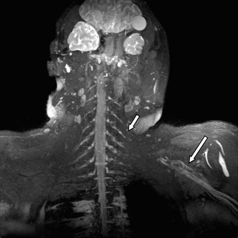 Brachial Plexus Injury Mri