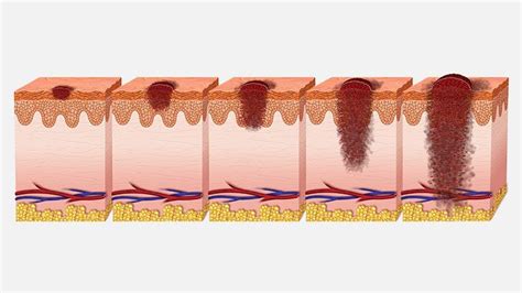 Melanoma or Liver Spots? How to Tell the Difference